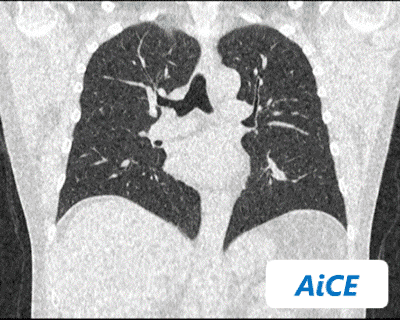 AiCEで処理した胸部CT撮影