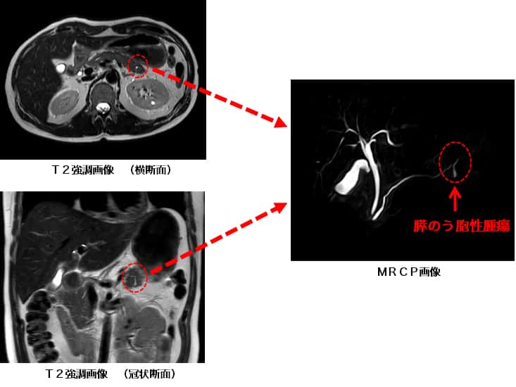 MRCP(MR胆管膵管撮影)